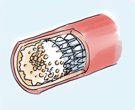 体检发现血管斑块尽早服药