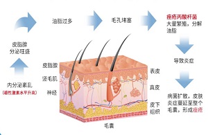 痤疮的护理常识有什么？最全“战痘”攻略来了