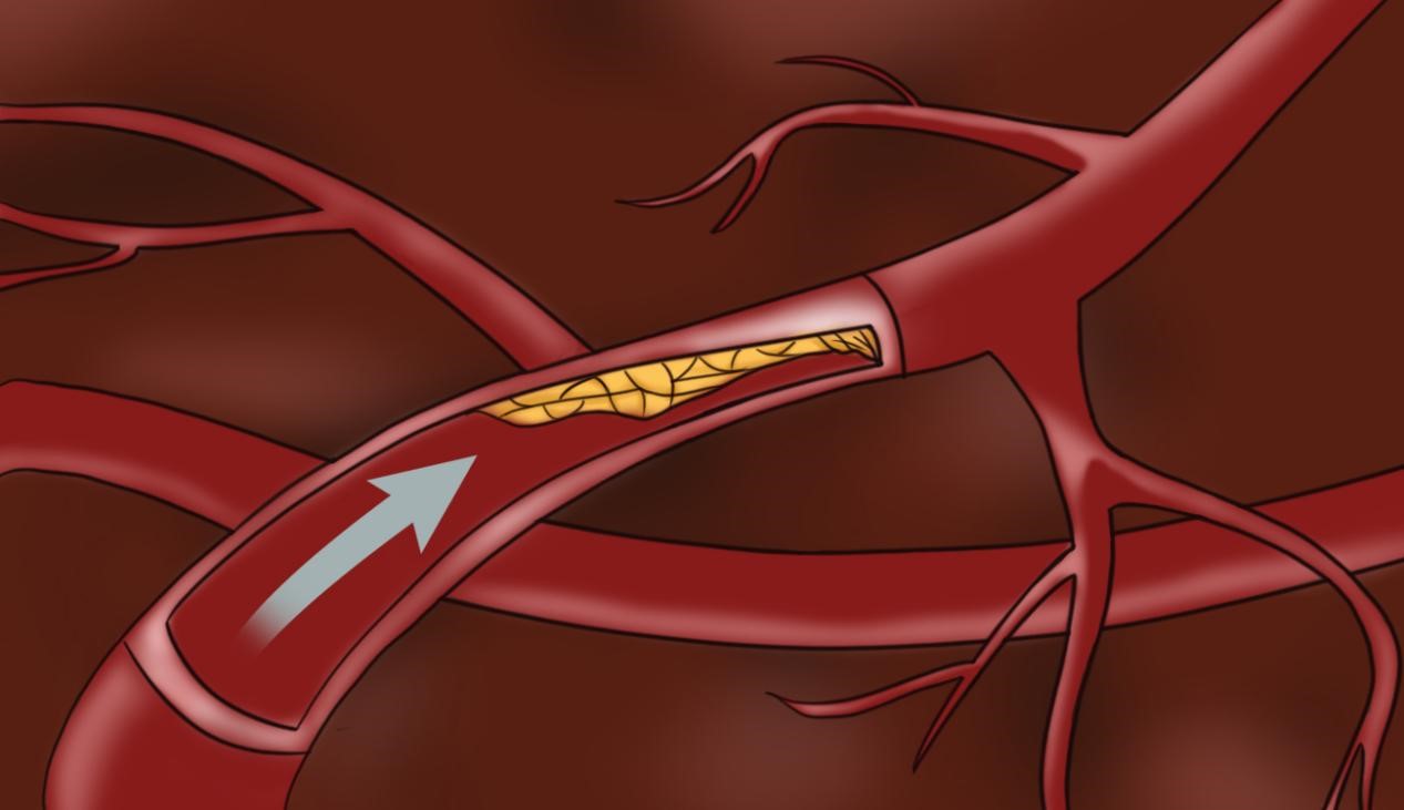 健康科普：颈动脉斑块怎么形成的