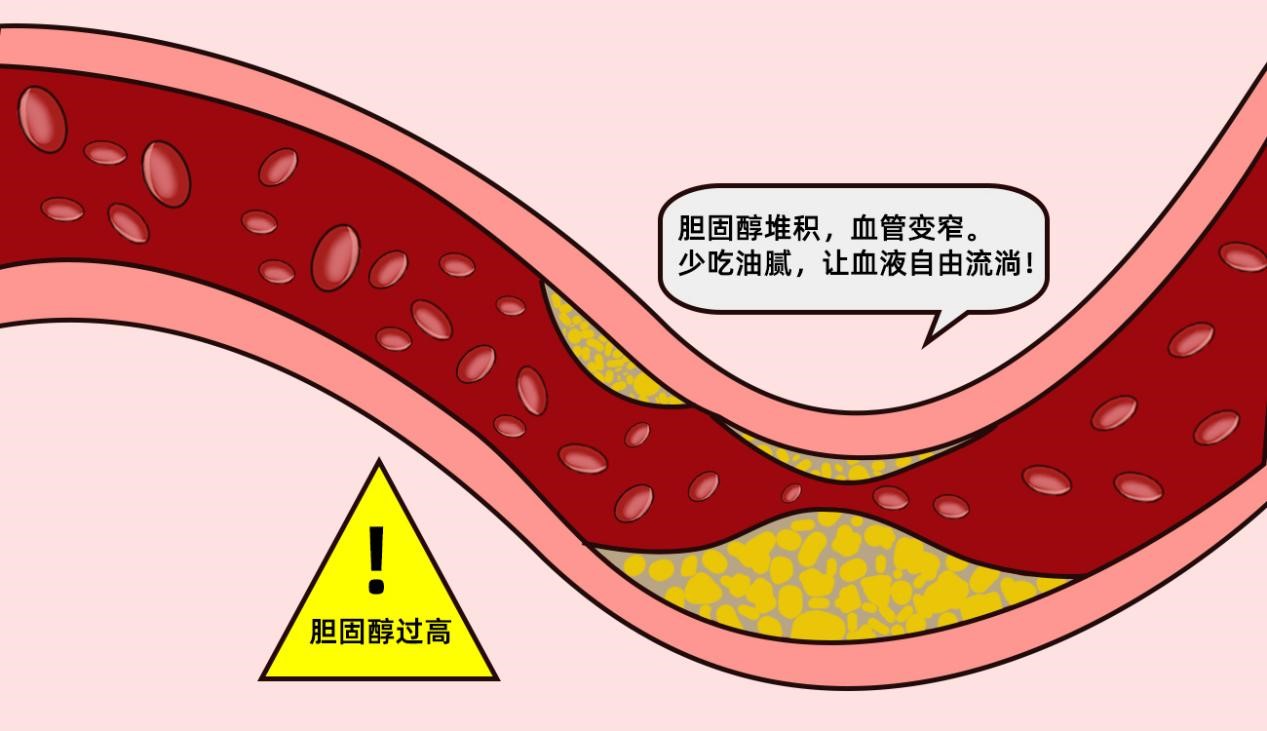 颈动脉斑块是什么原因造成的